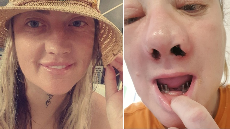 zubne implantáty