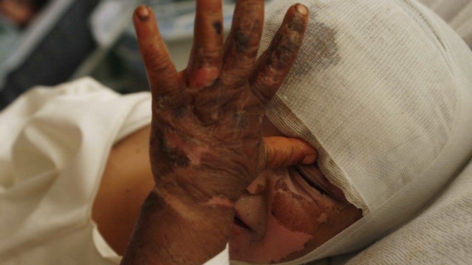 Popálené a ofačované dieťa, veľký detail tváre