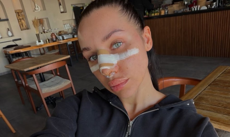 FOTO Bianka Rumanová je na nespoznanie! TAKTO vyzerá po operácii nosa